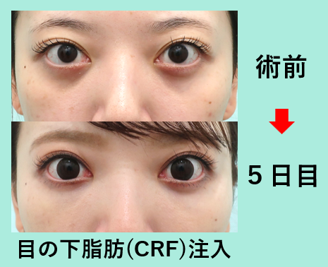 黑眼圈治疗案例参考图片
