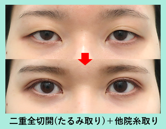 『肿胀比埋线还少的全切开,WOM CLINIC的高品质双眼皮切开』の画像