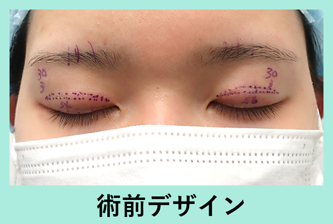 『肿胀比埋线还少的全切开,WOM CLINIC的高品质双眼皮切开』の画像