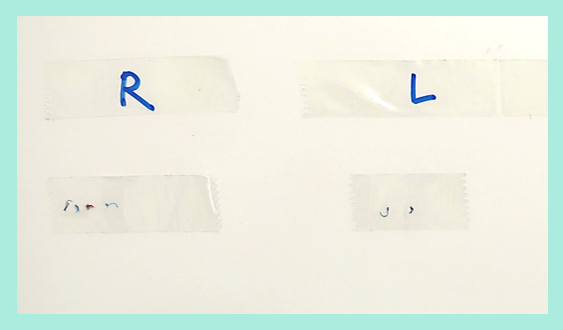 『肿胀比埋线还少的全切开,WOM CLINIC的高品质双眼皮切开』の画像