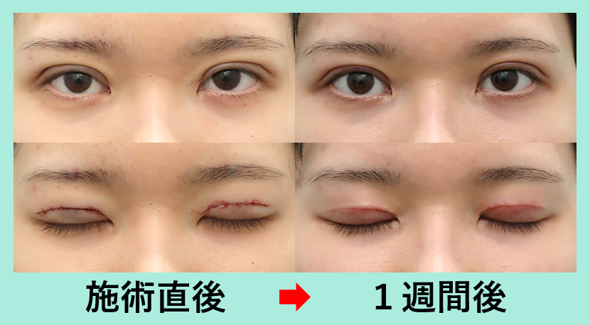 『肿胀比埋线还少的全切开,WOM CLINIC的高品质双眼皮切开』の画像