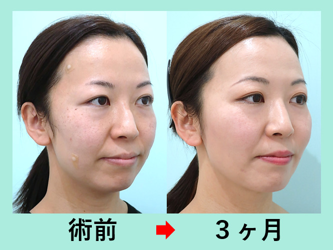 小脸・瘦脸治疗案例参考图片